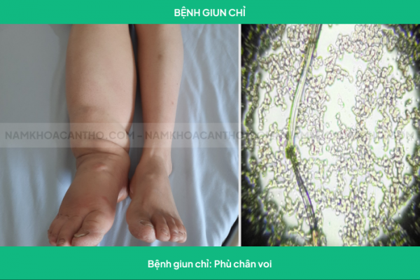 Bệnh giun chỉ: Phù chân voi