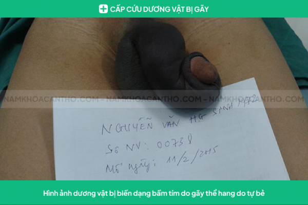 Cấp cứu gãy dương vật