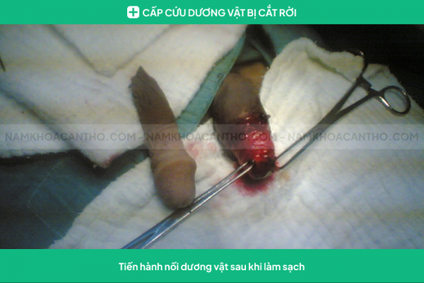 Cấp cứu phẫu thuật nối lại dương vật bị đứt rời