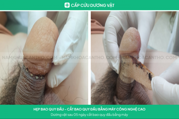 Cắt hẹp bao quy đầu bằng máy